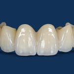 BruxZir® Zirconia Crowns and Bridges