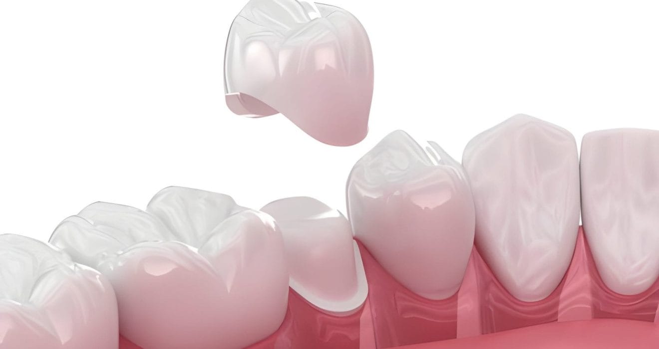 metal free dental crown