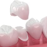 metal free dental crown