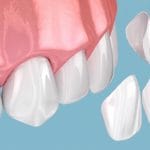 HT Zirconia Block