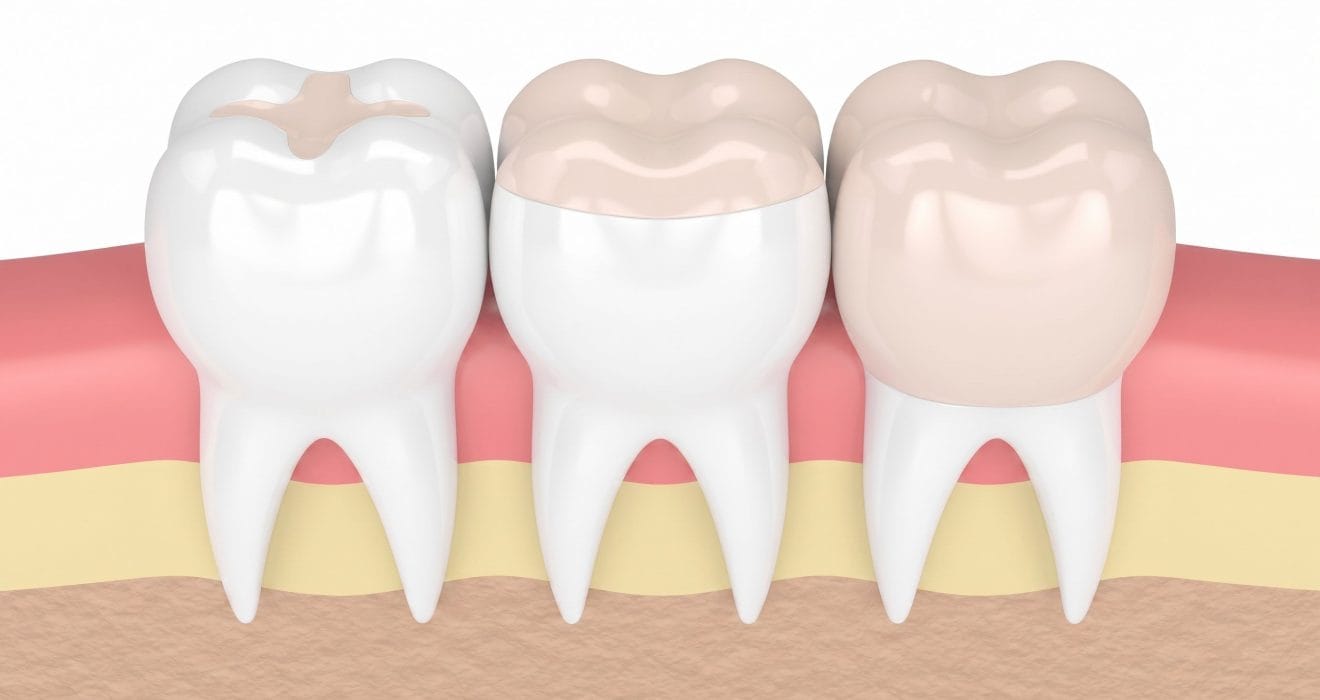 best full-contour zirconia