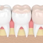 best full-contour zirconia