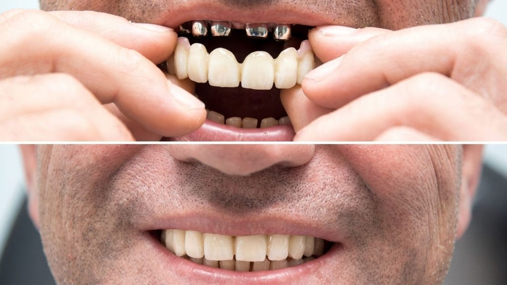 premium full-contour zirconia