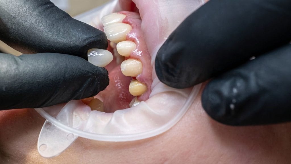 bruxzir anterior crown prep
