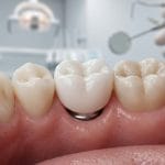 Bruxzir implant crown
